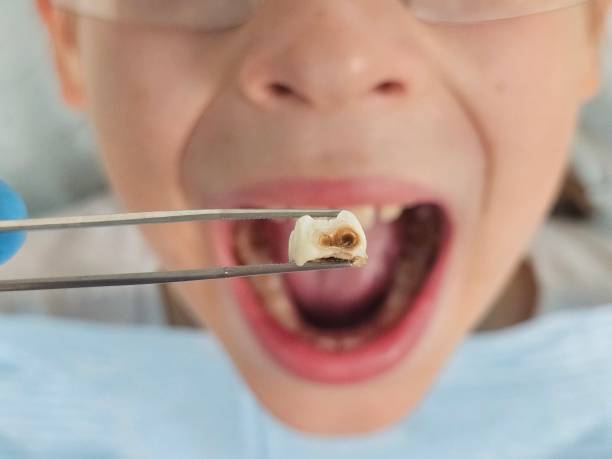 Best Emergency Tooth Extraction in Quitman, MS